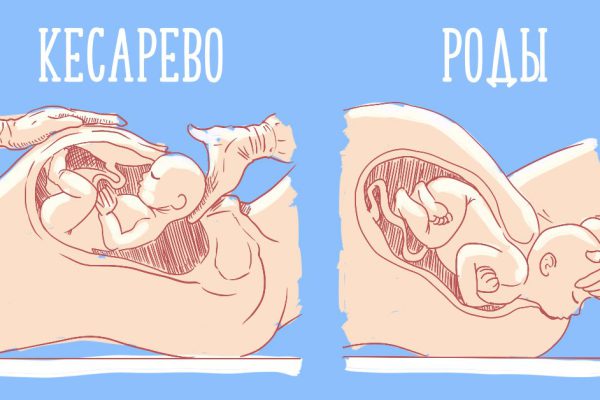 Дети-кесарята: чем они отличаются от обычных детей (ничем!). 3 мифа и 2 правды о необычных малышах.