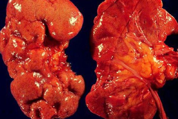 6 вредных привычек, которые повреждают почки. Позаботься о своем здоровье, пока не стало слишком поздно! 