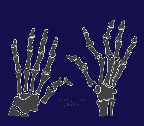 хруст суставов