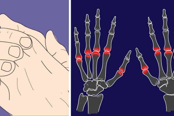 Ты думаешь, что знаешь всю правду о хрусте суставов? Прочти ЭТО…