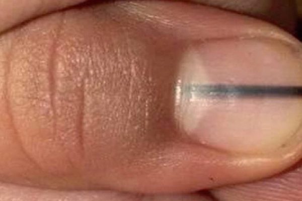 Темные полоски на ногтях — страшный признак! Онкологи предупреждают…