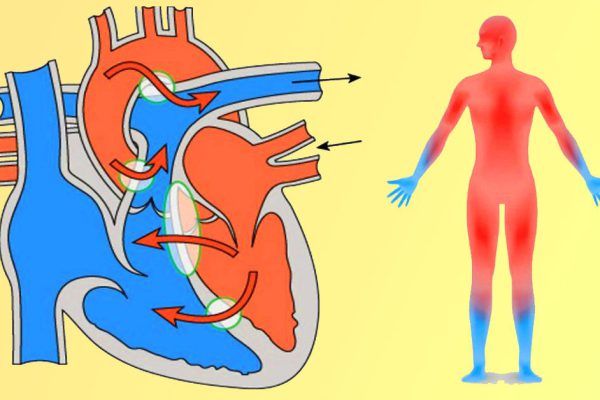 Плохое кровообращение? Предотвратить инфаркт, инсульт и приступы стенокардии поможет всего 1 продукт.