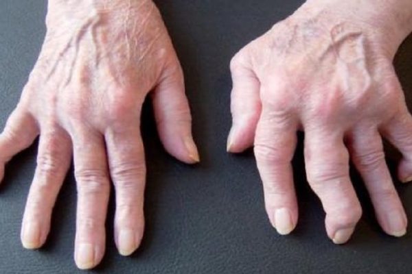 Этот чудо-продукт помог искоренить боль при артрите раз и навсегда. Чувствую облегчение!