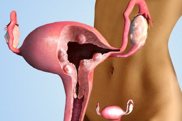 Появление эрозии шейки матки