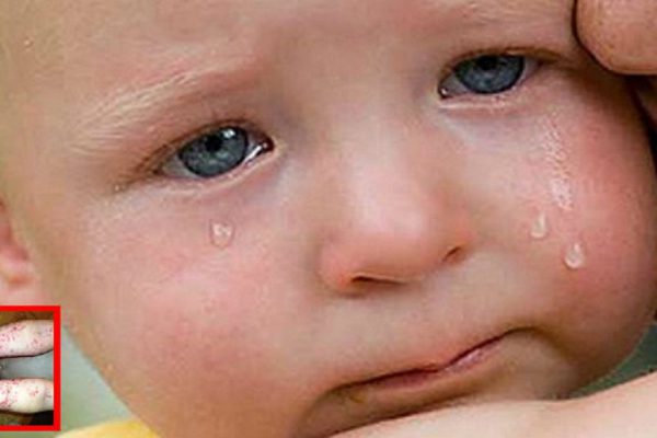 Мать заметила на теле у сына подозрительную сыпь. Когда болезнь поразила кожу полностью, она поняла причину.