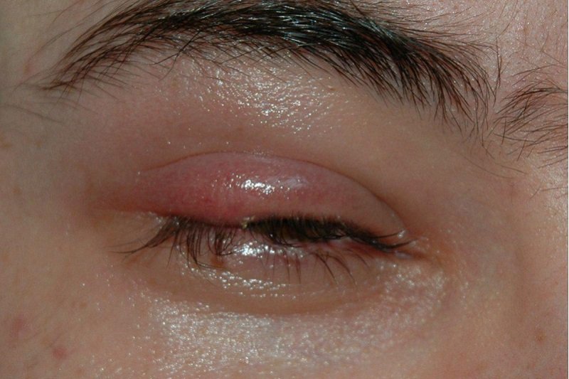 8 signálov, ktorými vás oči varujú pred zdravotnými problémami!