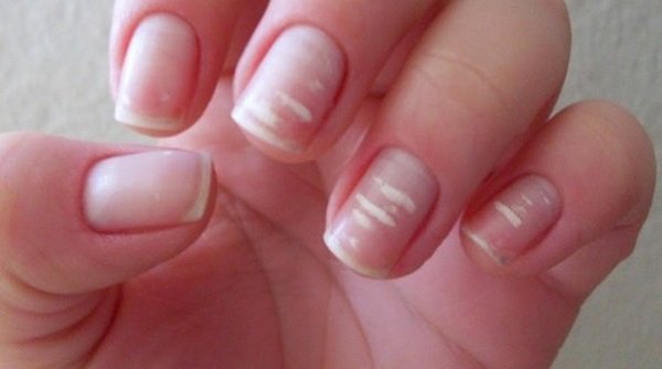 пятна на ногтях