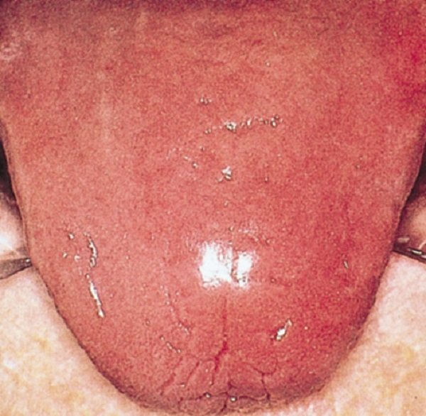 покраснение и рыхлость языка