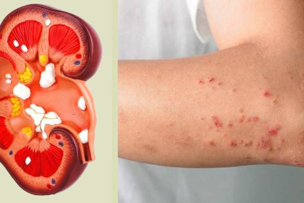 8 безошибочных признаков того, что твои почки не в порядке.