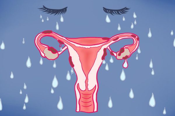 Эндометриоз — болезнь работающих женщин! Хоть бери и сегодня же увольняйся…