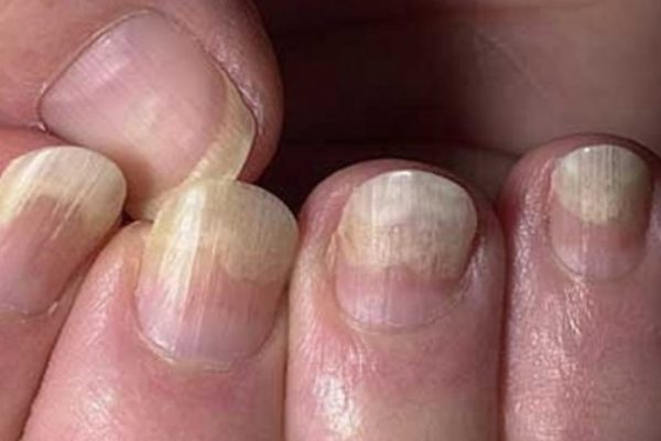 Симптомы, которые кричат о нехватке витаминов. Так вот почему мне постоянно хочется сладкого!