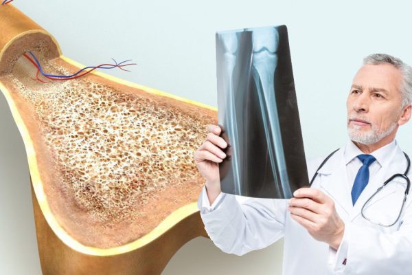 Хрупкие кости: как распознать и победить остеопороз. Очень важно удержать кальций…