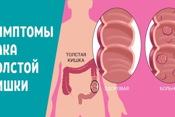 5 тревожных признаков рака толстой кишки. При первом дискомфорте в этой области спеши на обследование!