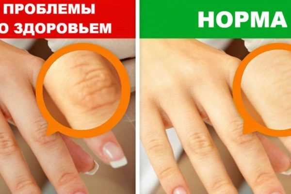 9 опасных заболеваний, о которых сигнализируют руки. Присмотрись внимательнее.