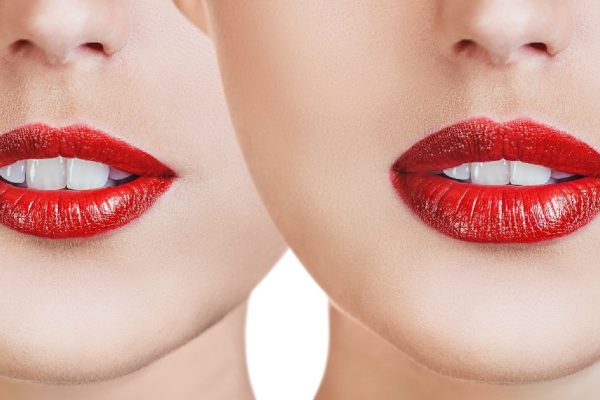 Red lips of young woman before and after filler injections