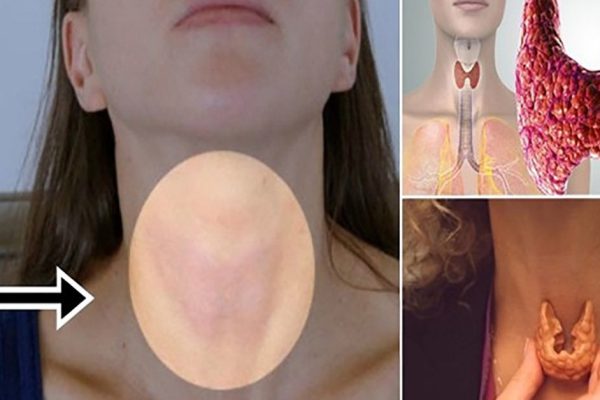 Больше никаких врачей! Лекарство от заболеваний щитовидки находится дома.