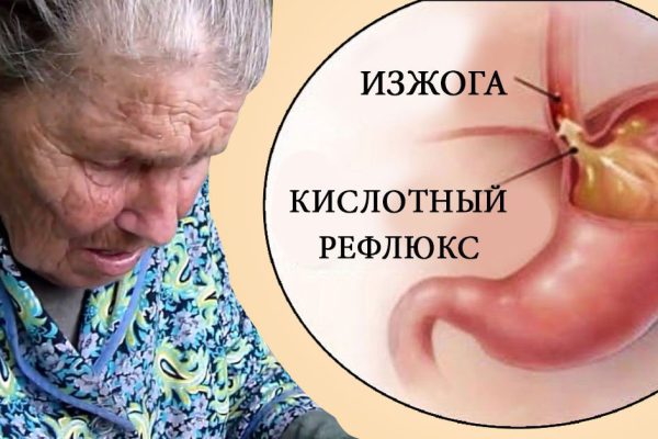 Чем опасна «просто изжога» и как ее избежать.