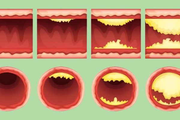 10 суперпродуктов для эффективного очищения артерий и профилактики инфаркта!