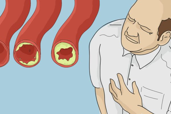 15 лучших продуктов для очищения артерий и профилактики инфаркта миокарда: живи дольше!