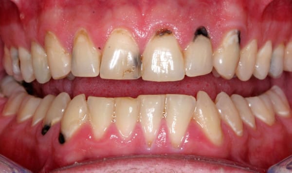профилактика кариеса молочных зубов
