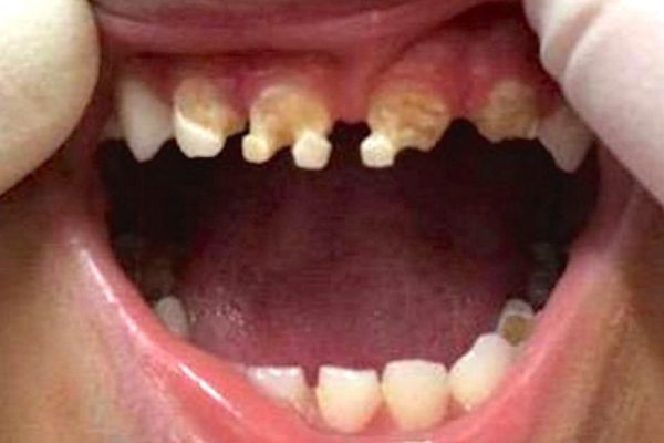 Когда врач увидел зубы 3-летнего ребенка, он задал матери всего один вопрос…