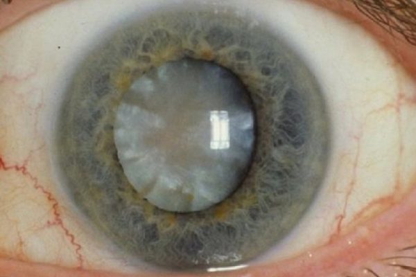 Лучшая профилактика катаракты! Больше никаких операций.