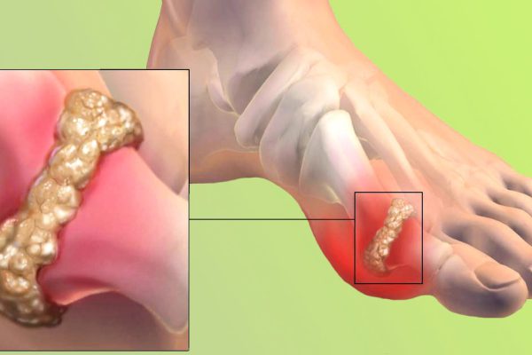 Целительное средство, которое вытягивает всю боль из ног! Чтобы суставы перестали болеть, а подагра отступила…