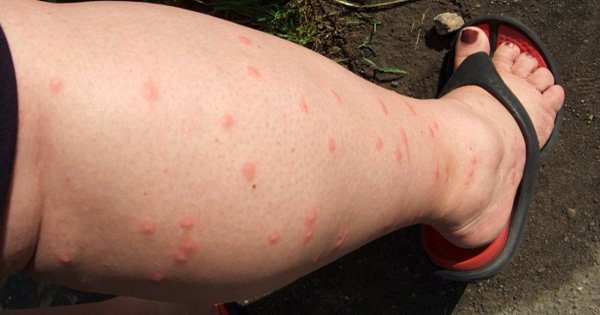 Теперь о комарах можно забыть! Простое средство от насекомых, сделанное в домашних условиях.