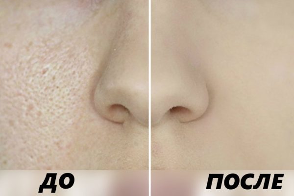 Поры на лице: как сузить и очистить. Простые и эффективные рекомендации!