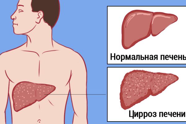 Мы травим свою печень одним привычным продуктом! Настоящая гадость…
