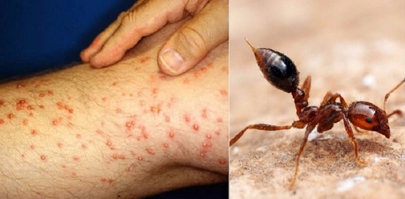 реакция кожи на укус насекомых