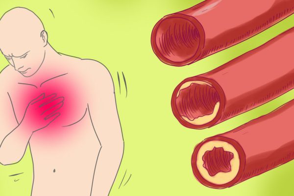 Очистка сосудов без таблеток! Давление всегда будет 120 на 80, если…