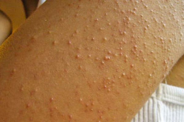 Она понятия не имела, откуда взялась странная сыпь на руках… Тревожные сигналы серьезной болезни.