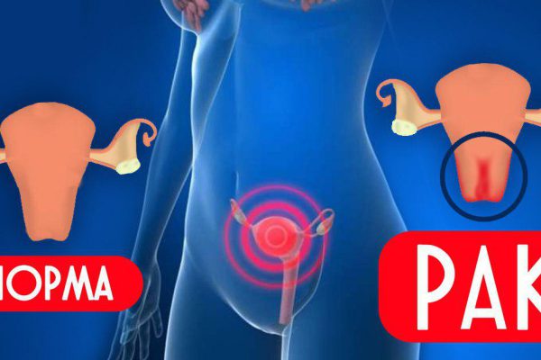 «Онкология, конечно, не ангина, но не окончательный приговор!» Чтобы выявить симптомы, нужно…