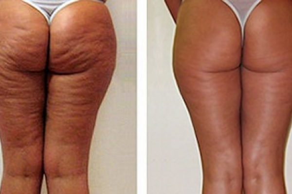 За это можно всё отдать! Пожалуй, самое доступное средство против целлюлита.