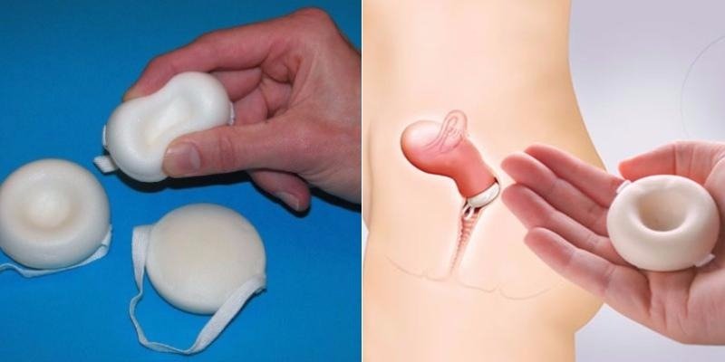популярные методы контрацепции