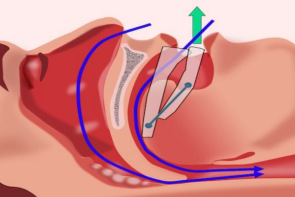 Храп по ночам ведет к опасным последствиям! Вот 3 продукта, которые решают проблему.