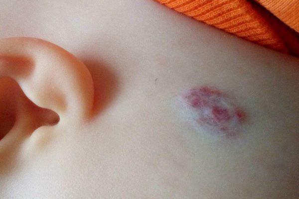 Вот что служит причиной развития меланомы… Доктор Комаровский объяснил, откуда приходит беда.