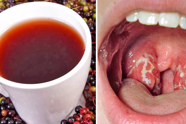 Натуральное средство от боли в горле: всего 4 часа — и симптомов ангины как не бывало!