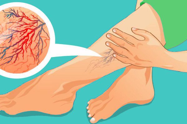 «Варикоз не любит, когда ваши ноги…» Варикоз пройдет даже после 50 лет, если взять сок алоэ, луковый сок и быстро…