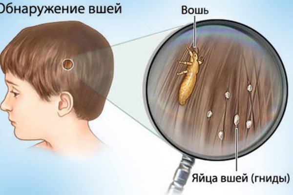 Эффективней средства не найти даже в аптеке! Паразиты чахнут, стоит лишь помыть голову…