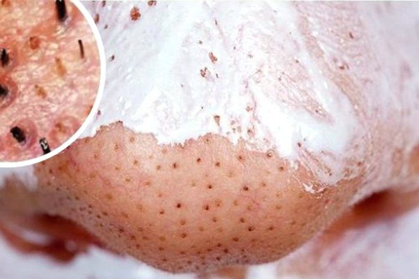 Единственное средство, которое действительно помогло убрать черные точки! Со-ве-ту-ю.