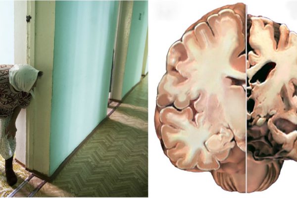 Кому грозит СТАРЧЕСКОЕ СЛАБОУМИЕ. Точный ответ академика Бехтерева.