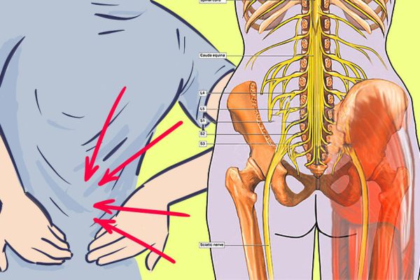 Попрощайся с седалищной невралгией за 10 минут, познакомившись с этим естественным способом!