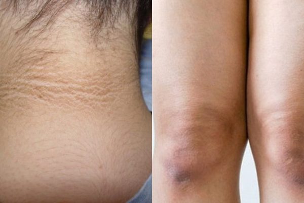 Я стеснялась носить одежду с короткими рукавами из-за черных локтей. Диву далась, когда увидела эффект от этого средства!