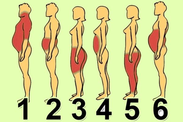 6 типов ожирения: о чём говорят лишние сантиметры на твоем теле.