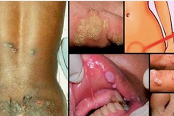 Новая болезнь, не подцепить которую можно только укрепив иммунитет! Аж мурашки по коже…