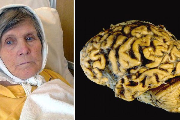 Болезнь Альцгеймера можно предотвратить! Всего 1 упражнение в день спасет твою память…