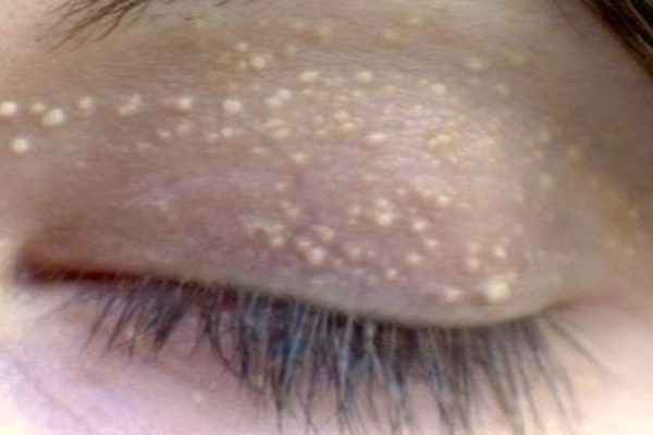 Она не на шутку испугалась, заметив вокруг глаз эти белые пятнышки… Вот что помогло всё исправить!