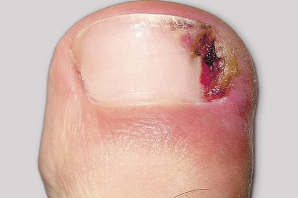 Адская боль! Вросший ноготь изводил меня давно, пока случайно не наткнулся на это средство…